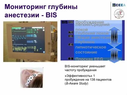 Мониторинг в анестезиологии