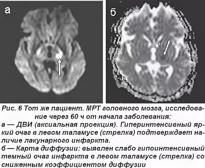 Вертебро базилярная инсульт