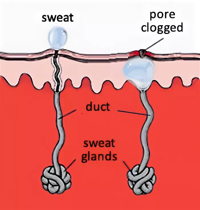 закупорка протоков железы