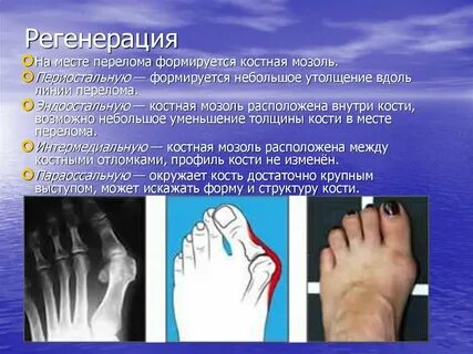 Место перелома