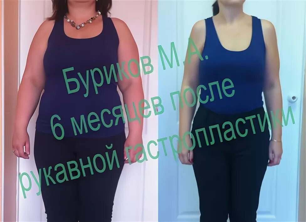 Операция по уменьшению желудка ростов. Пластика желудка для похудения в москве. операция по уменьшению желудка. рукавная гастропластика. резекция желудка для похудения в махачкале.