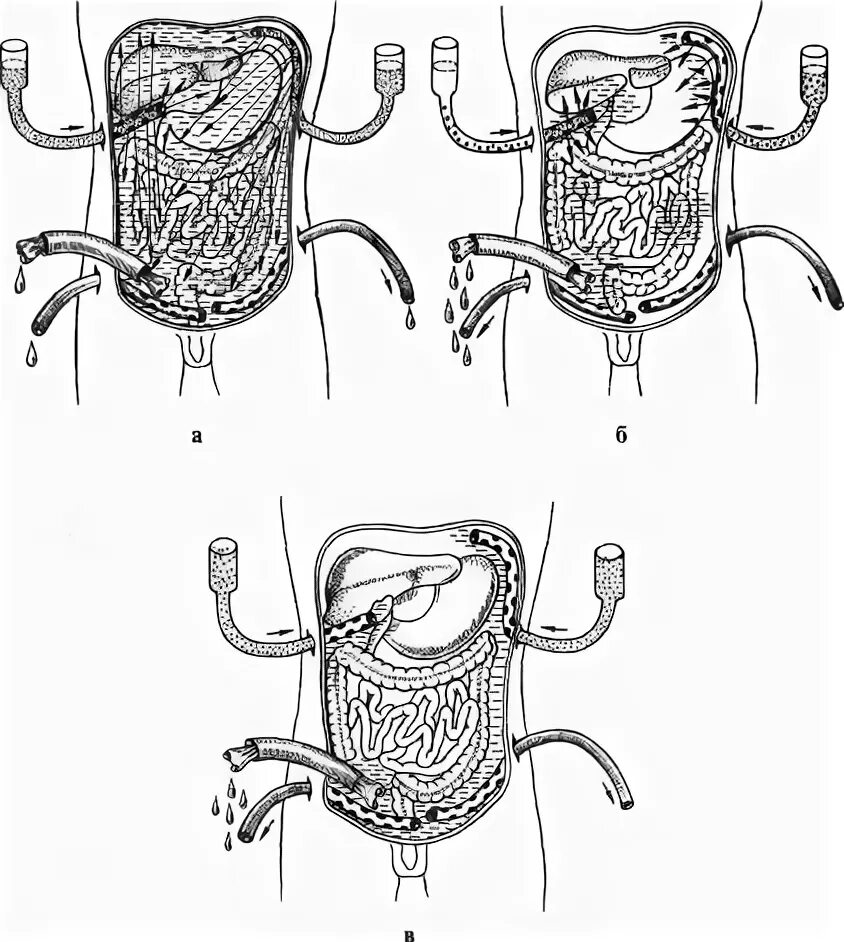 Что такое санация кишечника. Перитонеальный лаваж при перитоните. Лаваж брюшной полости. Проточный перитонеальный лаваж. Лаваж брюшной полости при перитоните.