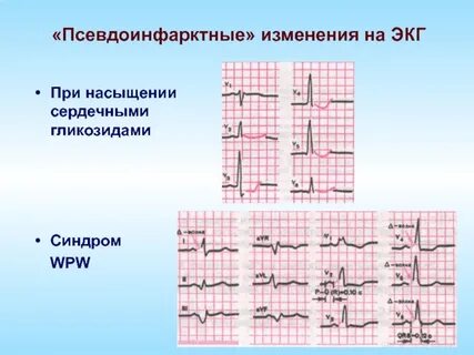 Интоксикация на экг