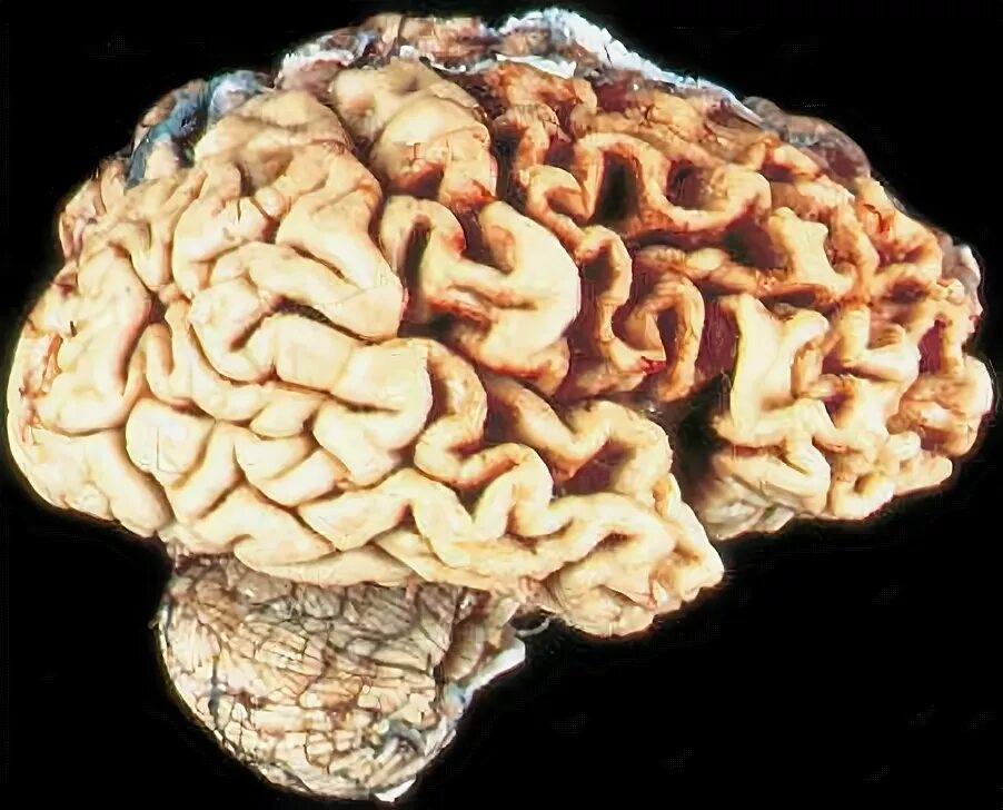Дегенерация головного мозга.