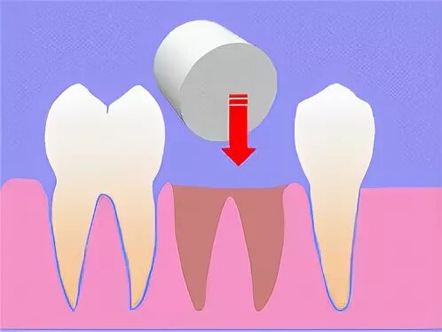 Остановить кровотечение удаления зуба. Сгусток в лунке удалённого зуба. Кровяной сгусток в лунке зуба.