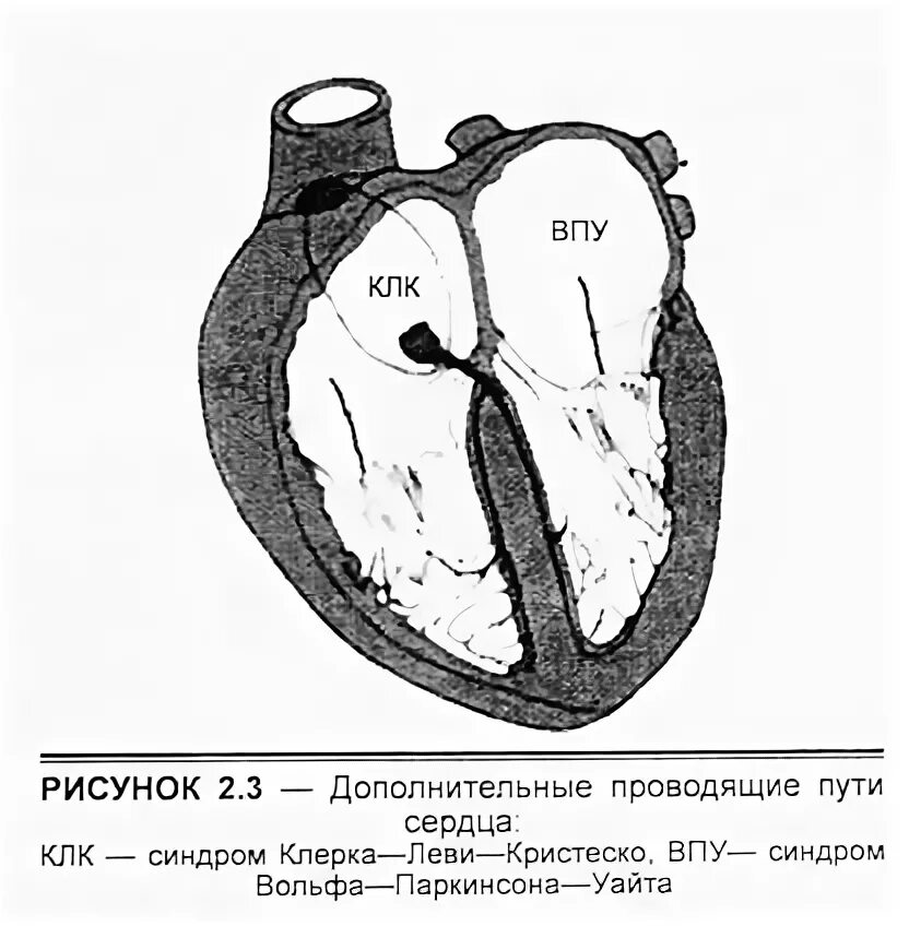 Пучок джеймса экг. Экг при синдроме clc. Синдром клерка леви кристеско. Синдром clc (клерка — леви — кристеско). Синдром clc в кардиологии.