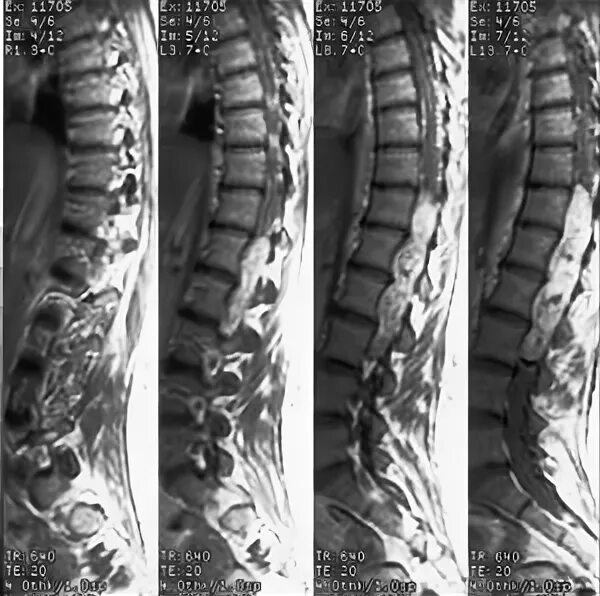 Эпендимома мрт позвоночника. Опухоль позвоночника мрт. Мрт снимки позвоночника с опухолью.