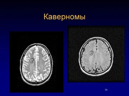 Кавернома головного