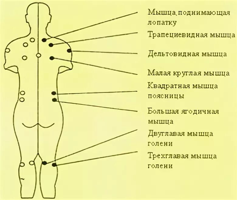 Точки на пояснице. Массаж спины схема болевые точки. Болевые точки на пояснице схема. Триггерные точки на спине схема. Триггерные точки при фибромиалгии.