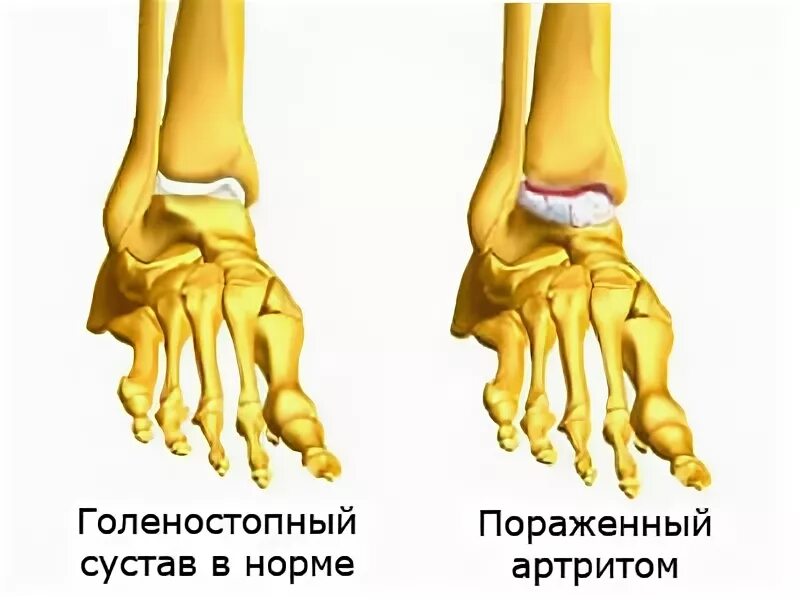 Серозный артрит голеностопного сустава. Острый артрит голеностопного Сус.