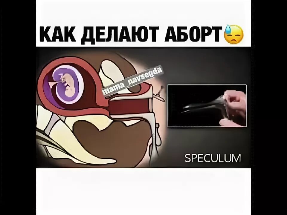 Как сделать оборот самой. Как сделать аборт вешалкой. как сделать аборт с помощью вешалки. аборт металлической вешалкой.