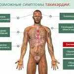 Боль при тахикардии