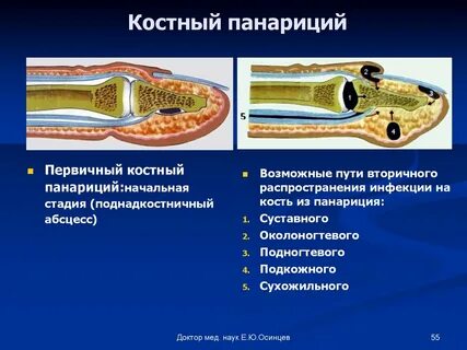Панариций мкб