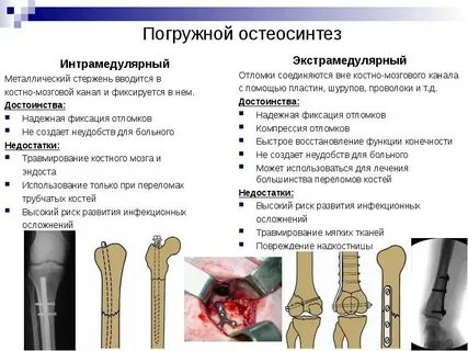 Остеосинтез классификация