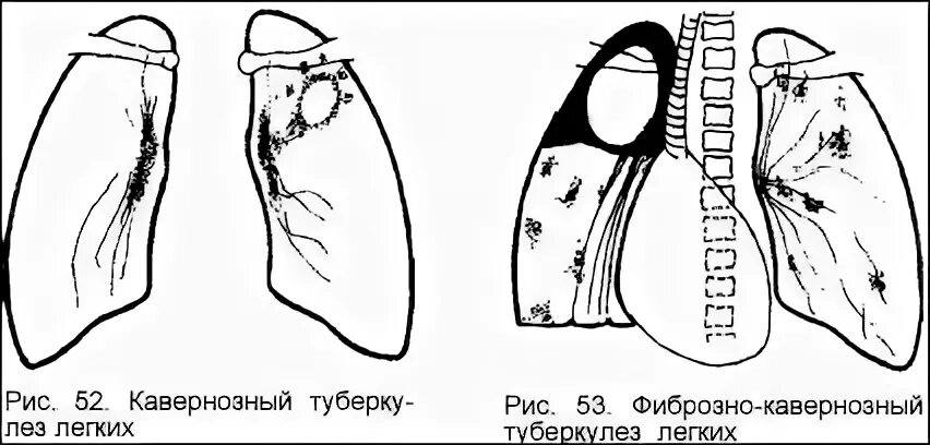 Фиброзно кавернозный туберкулез мбт