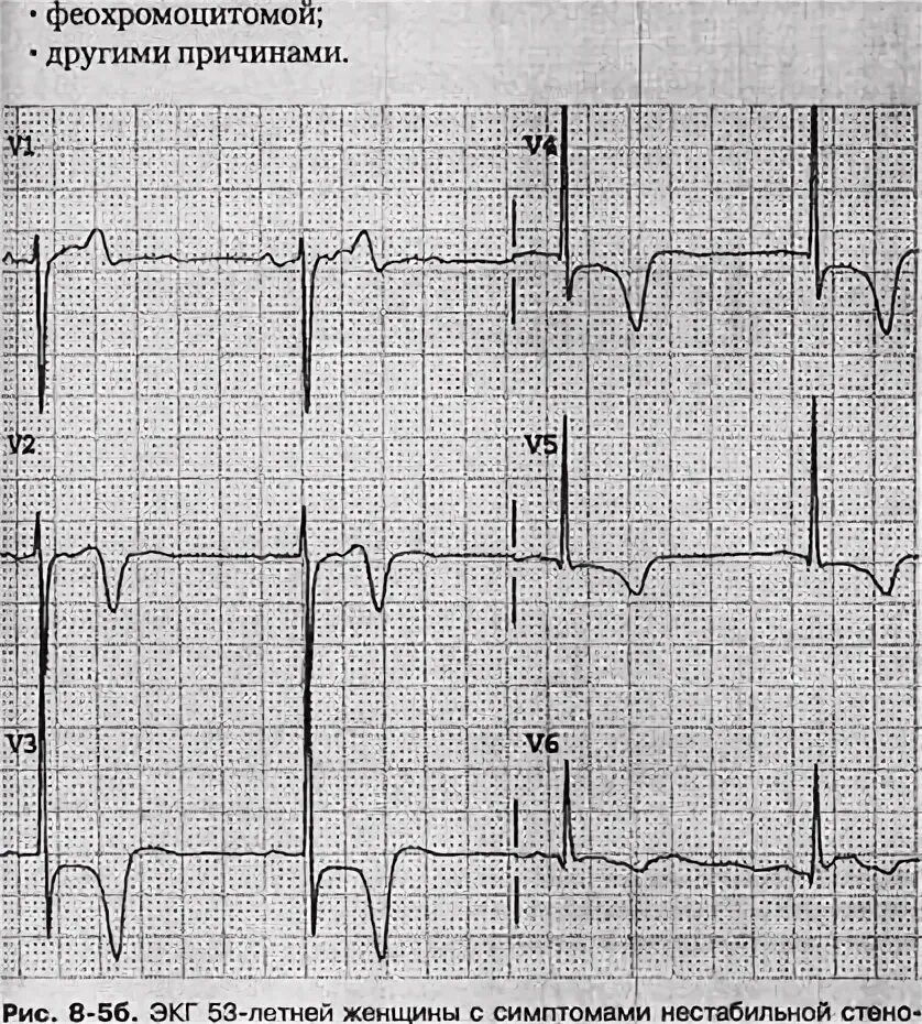 Что значит зубец т. Отрицательный зубец т в v2-v6. отрицательный зубец т в v2 на экг. отрицательный т в v1 отведении. отрицательный зубец т в v1 на экг.