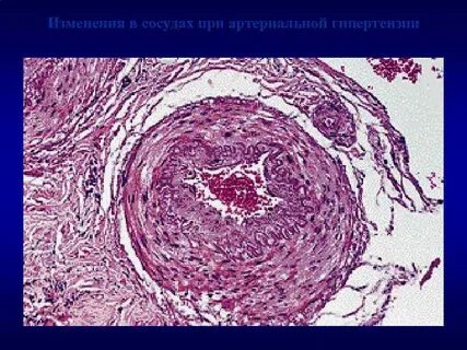 Изменения сосудов