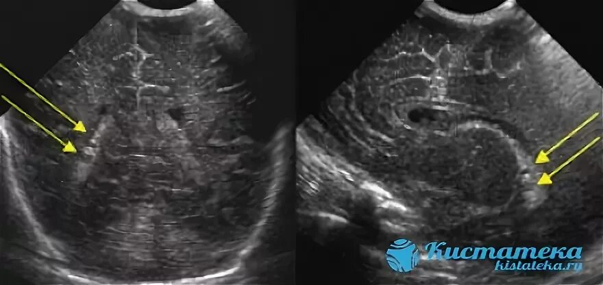 У плода киста мозга сплетения. Кисты сосудистых сплетений НСГ. Субэпендимальная киста нейросонография. Киста сосудистого сплетения УЗИ. Нейросонография новорожденных кисты сосудистых сплетений.