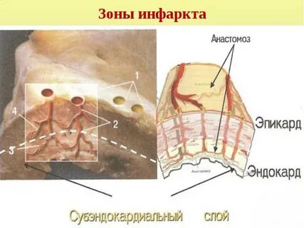 Зоны инфаркта