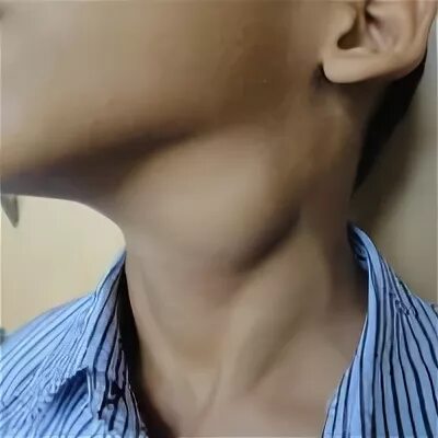 мужская шея. кадык у детей. увеличенная щитовидная железа. тонкая мужская шея. мальчик с большой головой.