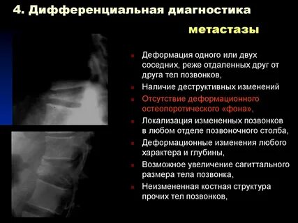 Диагноз метастаз