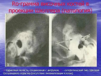 Рентген височных