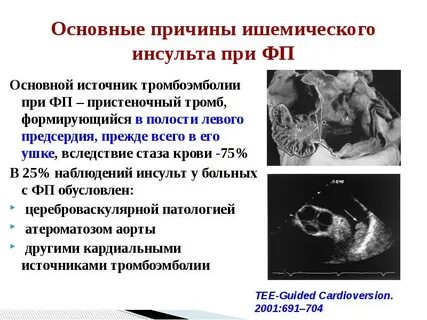Тромб в ухе