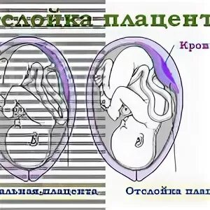 Степень зрелости плаценты 3. Плацента на 34 неделе беременности. Предлежание плаценты норма. Плацента на 34 неделе беременности. Отслойка плаценты кровотечение.