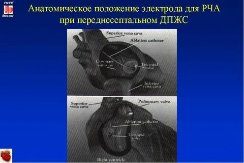 Сколько времени длится рча