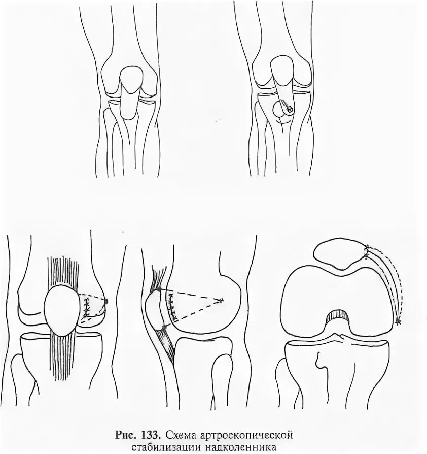 Латерализация надколенника. Операция подвывих надколенника. Степени вывиха надколенника. Медиальный вывих надколенника. Вывих надколенника операция.