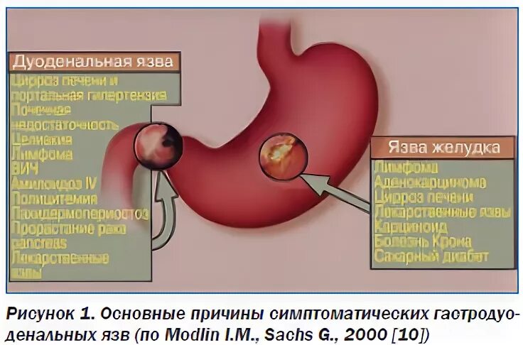Лечение гастропатии желудка