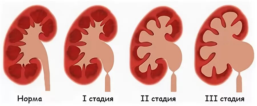 Лоханка 42 мм. Расширение почечной лоханки до 20 мм. Надпочечная лоханка. Расщепление ЧЛС правой почки. Что значит расширены лоханки почек