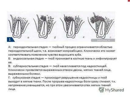 Расширенная щель