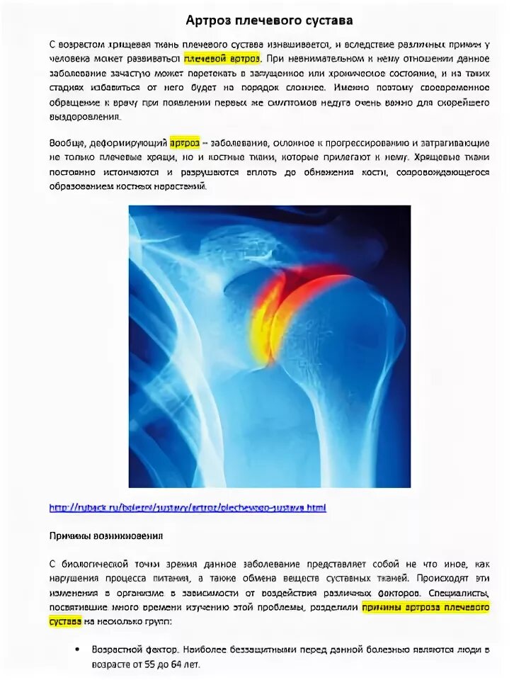 Как лечить артроз плечевого сустава 2 степени. Остеоартроз плечевых суставов рентген стадии. артроз плечевого сустава 1 степени рентген. артроз плечевого сустава рентген. омартроз артроз плечевого сустава 2 степени.