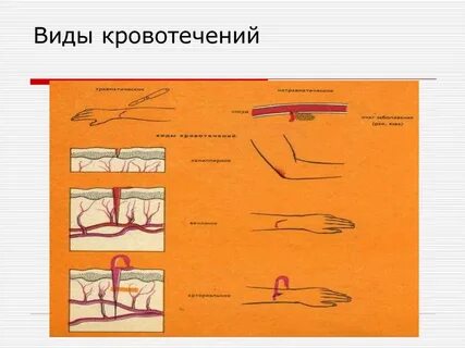 Виды кровотечения тест