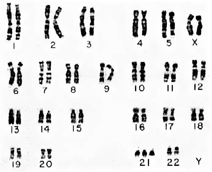 Синдром дауна лишняя хромосома. Синдром Дауна хромосомная карта. Синдром Дауна 21 хромосома. Кариотип при синдроме Дауна. Синдром Дауна хромосомный набор кариотип.