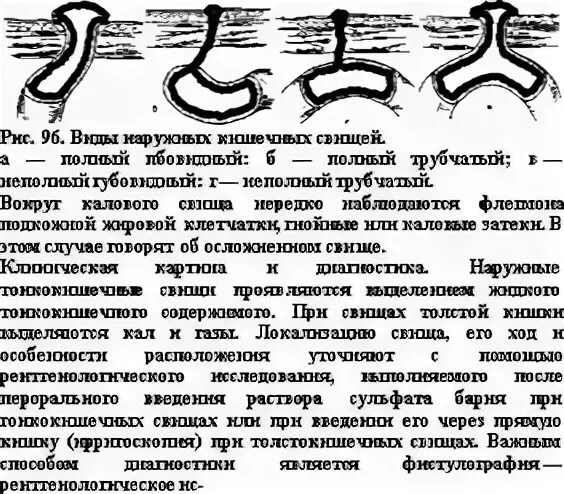 Операция по удалению свища прямой кишки в СПб - сделать иссечение хронического п