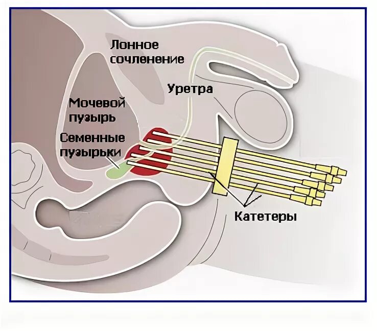 Брахитерапия простаты. Брахитерапия предстательной железы. аппликаторы для брахитерапии. брахитерапия мочевого пузыря. вибромассаж простаты.