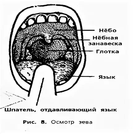 Зев гиперемирована миндалины. Задняя стенка глотки зернистая. Осмотр зева ребенка