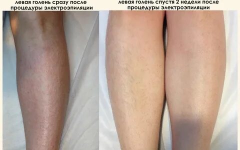 Электроэпиляция ставрополь