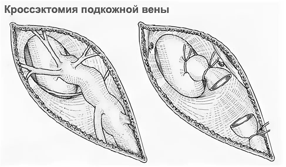 Кросэктомия. Операция мюллера минифлебэктомия. Кросэктомия. Кросэктомия. Операция кроссэктомия.