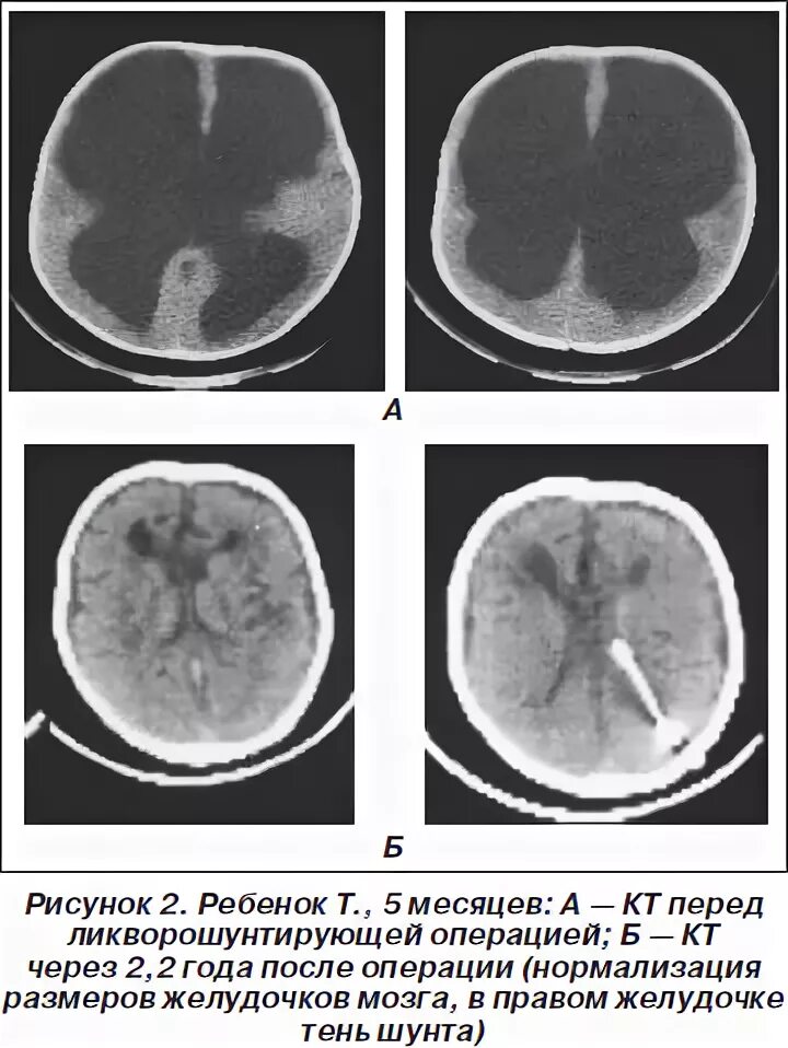 Неокклюзионная гидроцефалия. Окклюзионная гидроцефалия головного мозга кт. Компенсированная гидроцефалия кт. Гидроцефалия головного шунт. Гидроцефалия снимок мрт.
