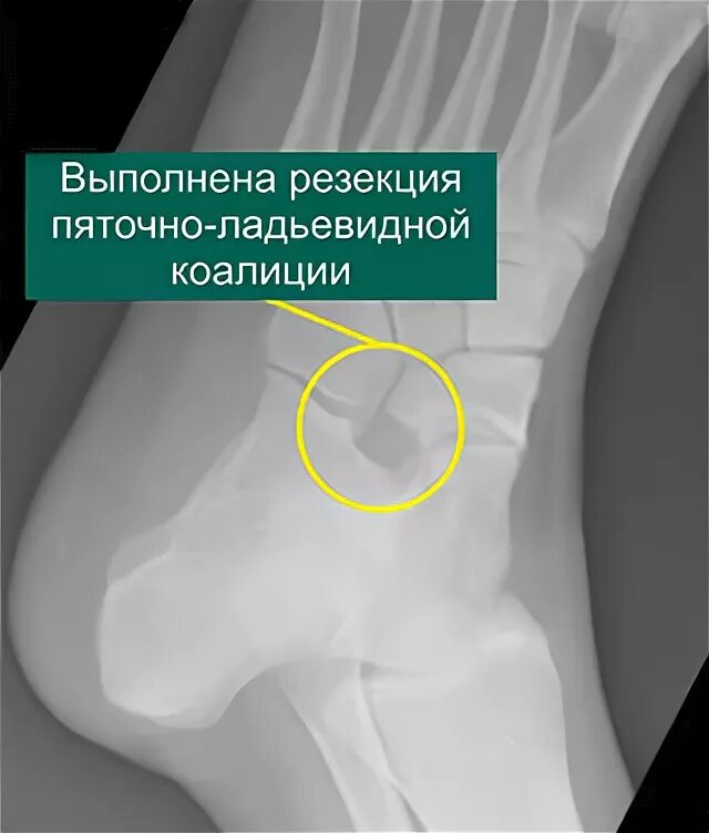 Костная киста пяточной кости. Таранно-пяточная коалиция. Ладьевидная кость стопы артроз. Тарзальная коалиция рентген. Пяточно коалиция.