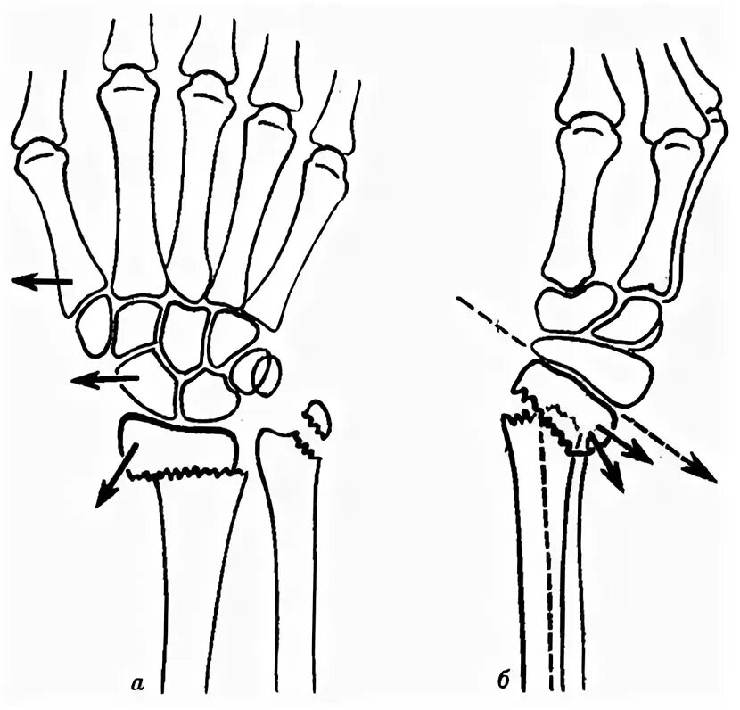 Перелом дистального метаэпифиза лучевой кости рентген. Перелом дистального метаэпифиза шиловидного отростка лучевой кости. Внутрисуставной перелом шиловидного отростка лучевой. Перелом эпиметафиза лучевой кости. Перелом дистального метаэпифиза локтевой кости.
