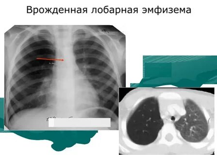 Врожденная долевая эмфизема