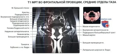 Энтезопатия средней ягодичной