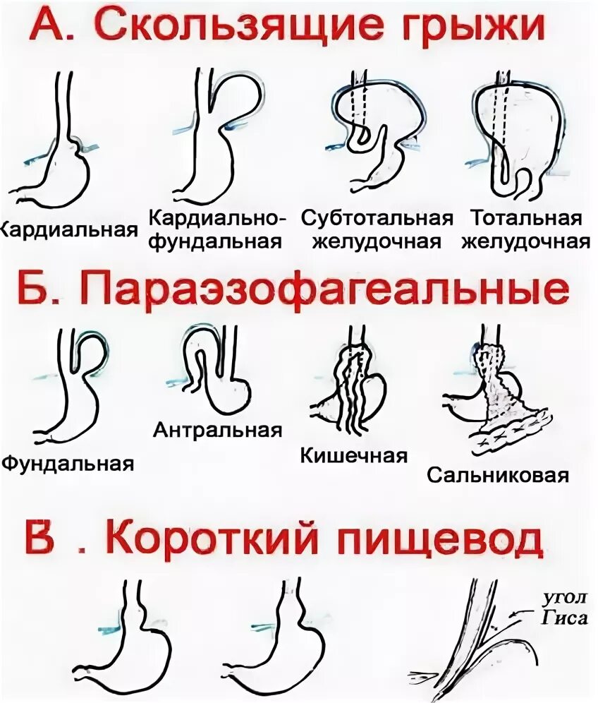 Является ли грыжа. Диета при грыже пищеводного отверстия диафрагмы меню и рецепты. упражнения при грыже пищеводного отверстия диафрагмы. аксиальная хиатальная грыжа. лекарства при грыже пищевода.