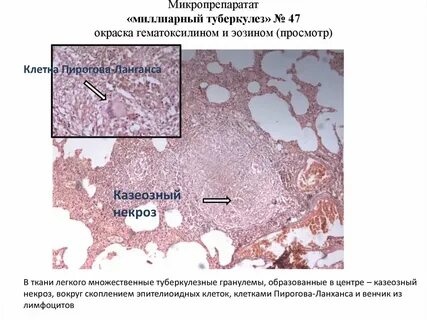 Туберкулез легких макропрепарат