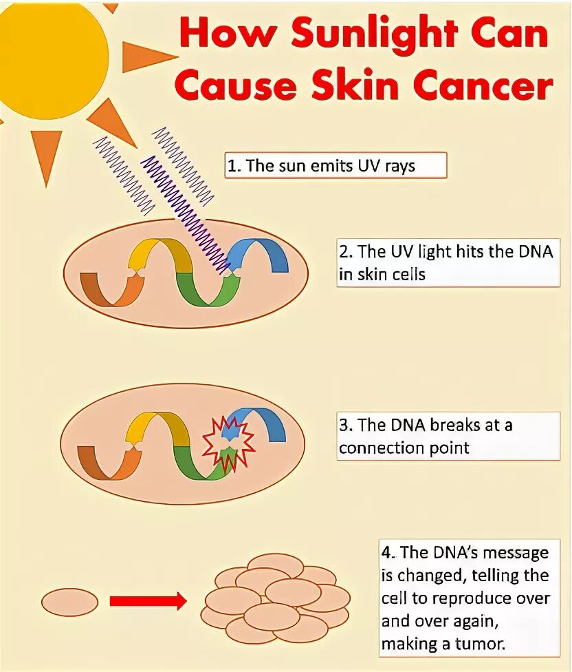 Cause cancer. UVB rays Sunburn and Skin Cancer.