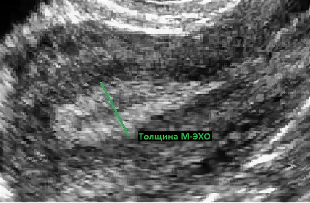 Субинволюция матки УЗИ. М Эхо на УЗИ. Лечение серозометра матки после 60